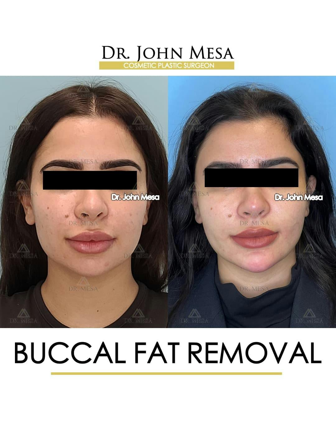 Buccal Fat Pad Removal Before & After Gallery - Patient 411296 - Image 1