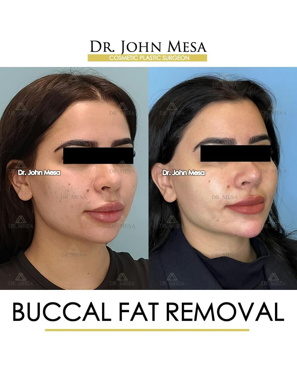 Buccal Fat Pad Removal Before & After Gallery - Patient 411296 - Image 2
