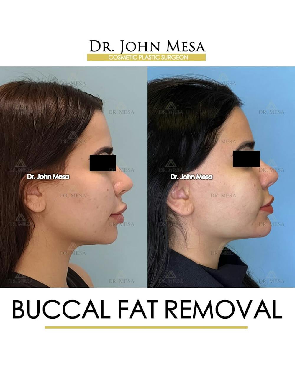 Buccal Fat Pad Removal Before & After Gallery - Patient 411296 - Image 3