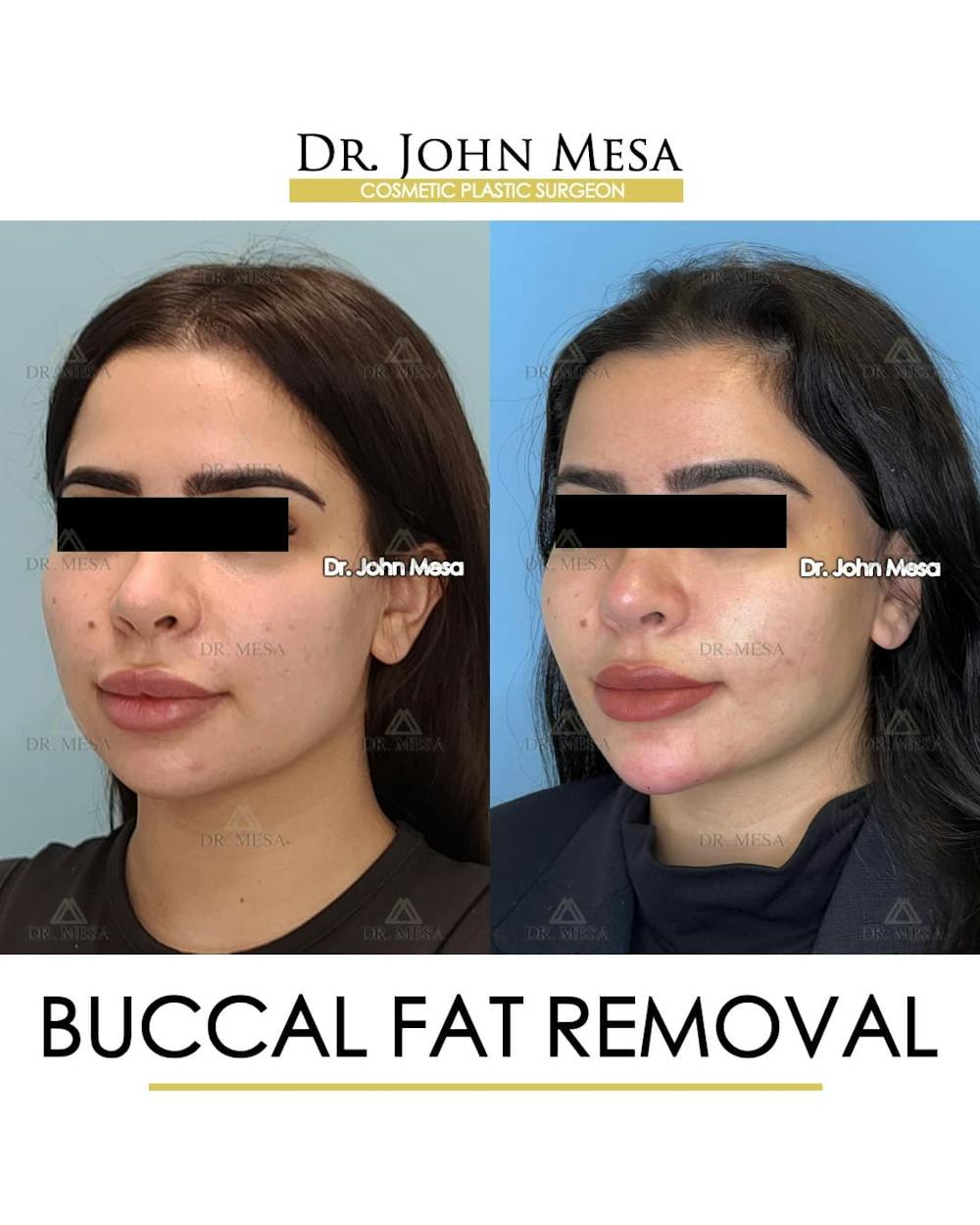 Buccal Fat Pad Removal Before & After Gallery - Patient 411296 - Image 4