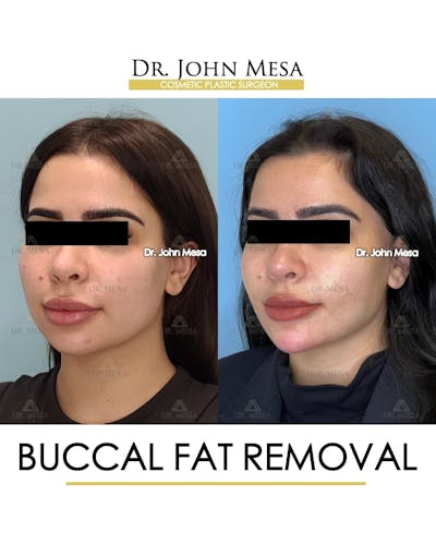 Buccal Fat Pad Removal Before & After Gallery - Patient 411296 - Image 4