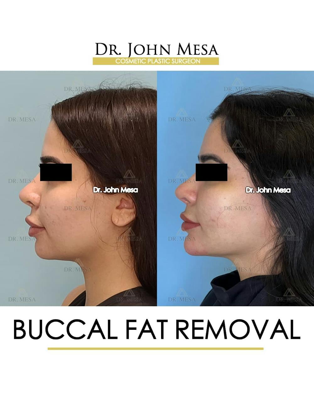 Buccal Fat Pad Removal Before & After Gallery - Patient 411296 - Image 5
