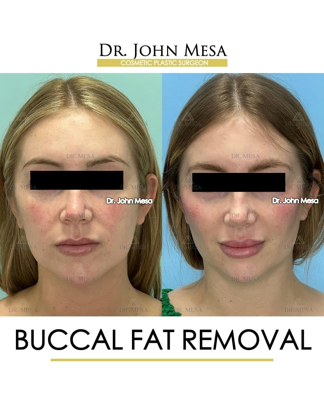 Buccal Fat Pad Removal Before & After Gallery - Patient 868696 - Image 1