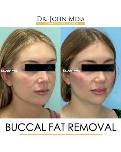 Buccal Fat Pad Removal Before & After Gallery - Patient 868696 - Image 2