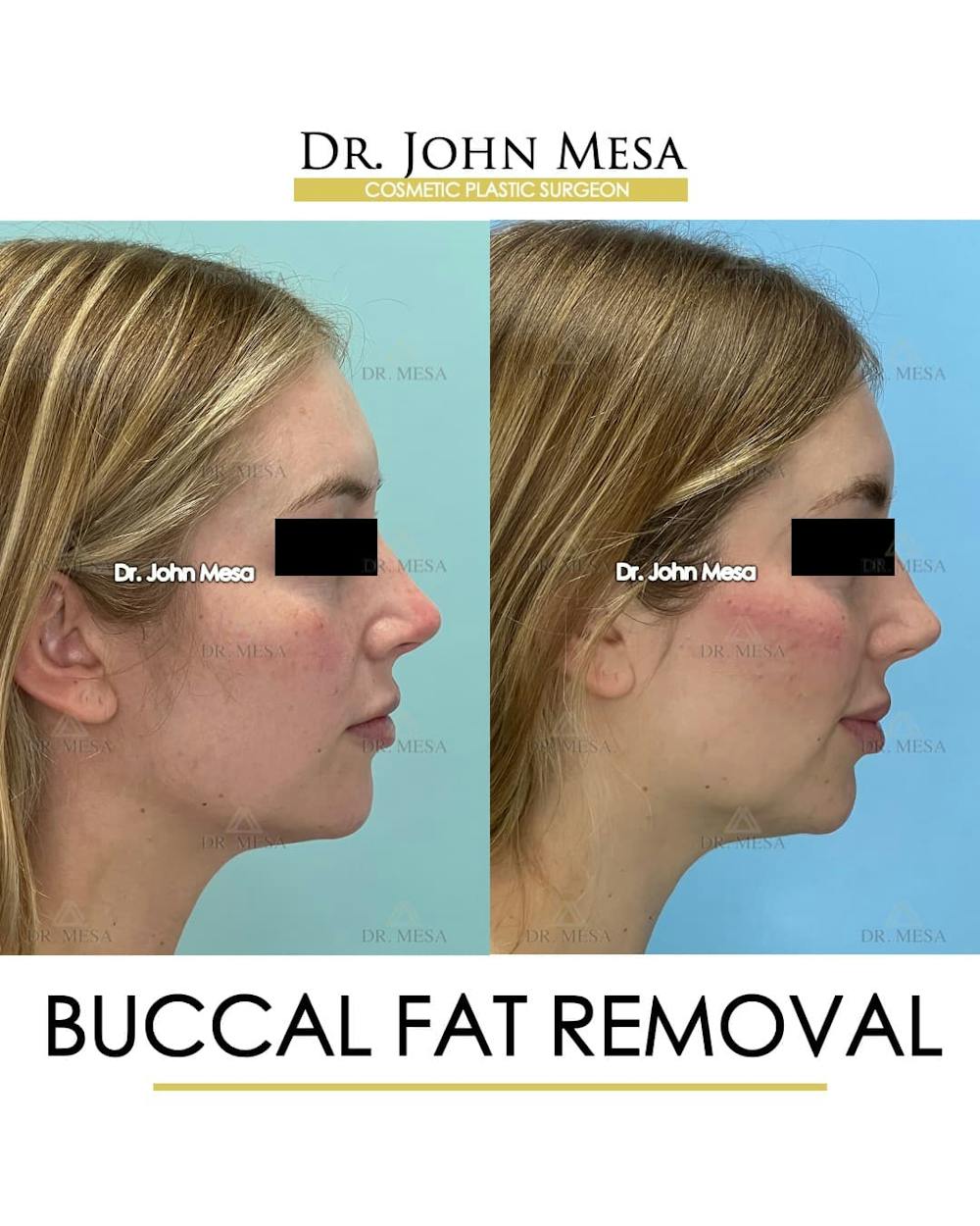 Buccal Fat Pad Removal Before & After Gallery - Patient 868696 - Image 3