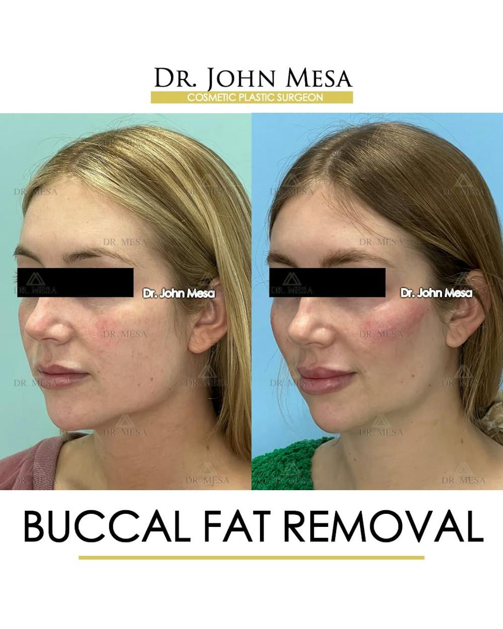 Buccal Fat Pad Removal Before & After Gallery - Patient 868696 - Image 4