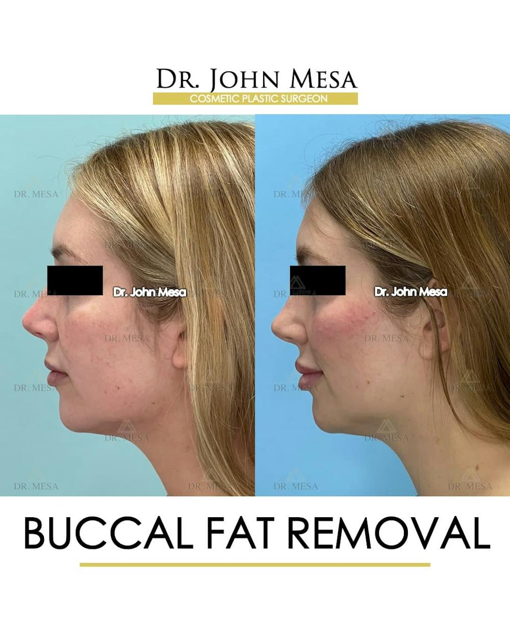 Buccal Fat Pad Removal Before & After Gallery - Patient 868696 - Image 5