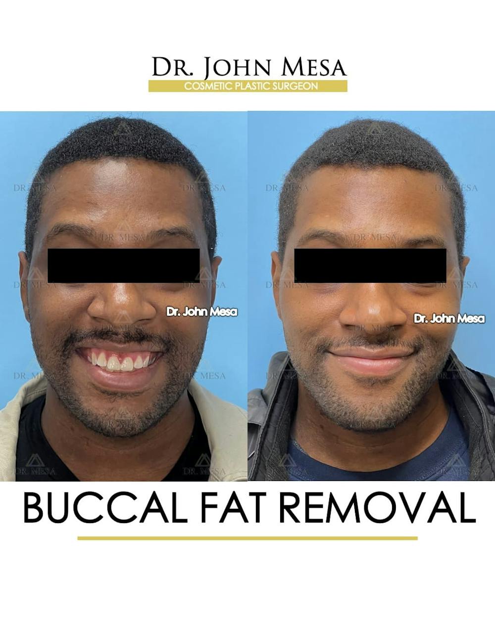 Buccal Fat Pad Removal for Men Before & After Gallery - Patient 624194 - Image 2