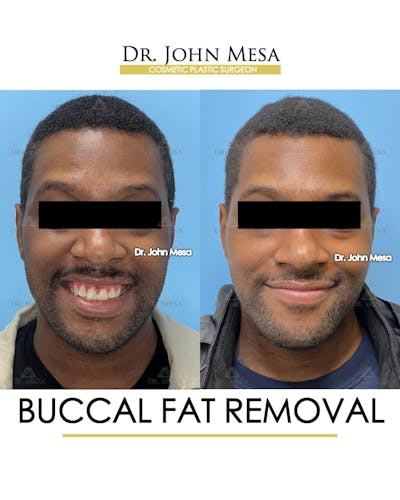 Buccal Fat Pad Removal for Men Before & After Gallery - Patient 624194 - Image 2