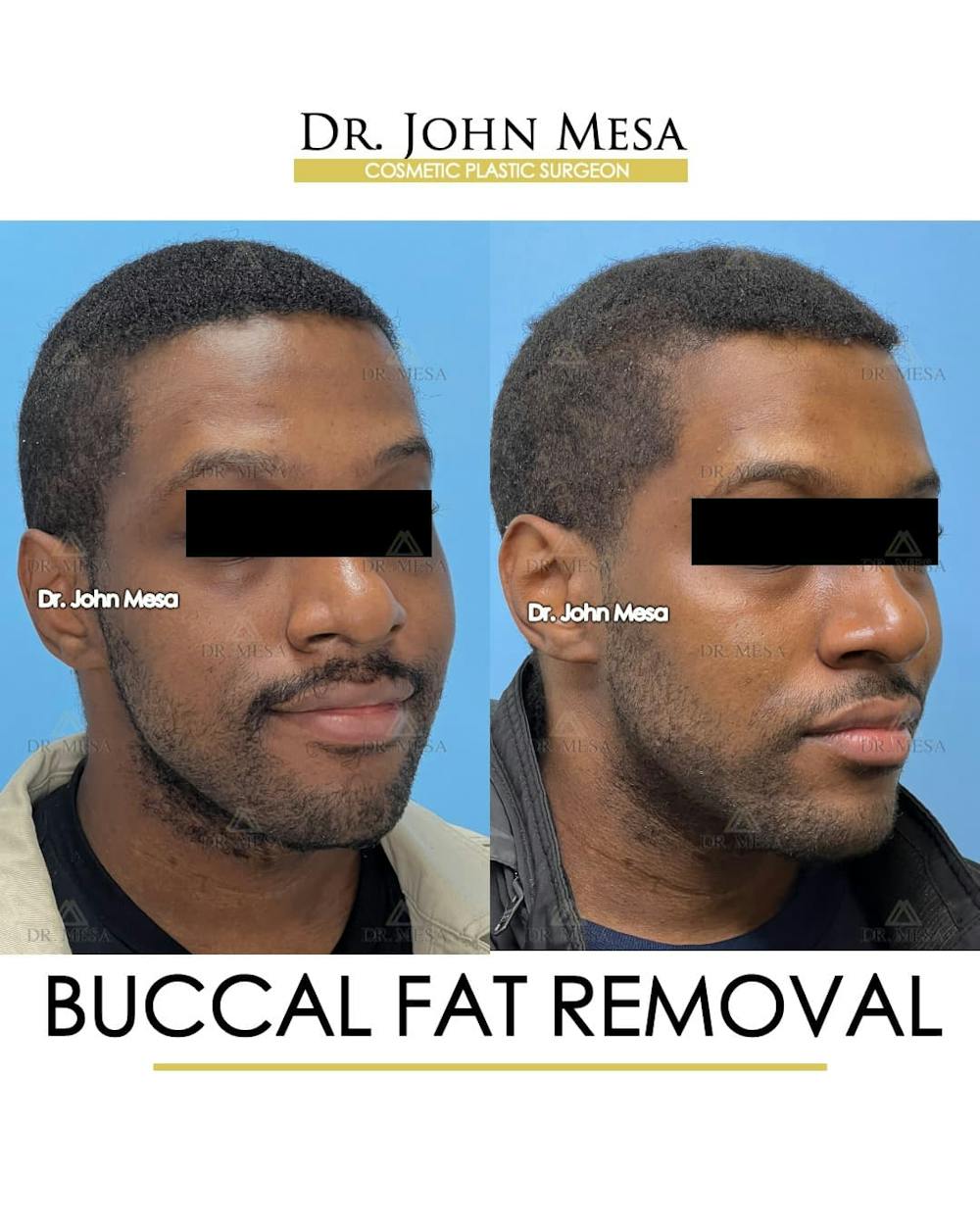 Buccal Fat Pad Removal for Men Before & After Gallery - Patient 624194 - Image 3