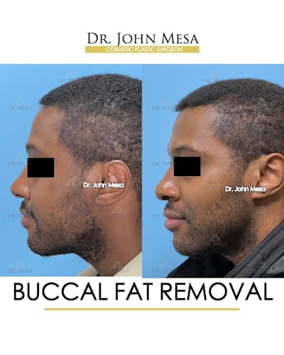Buccal Fat Pad Removal for Men Before & After Gallery - Patient 624194 - Image 4