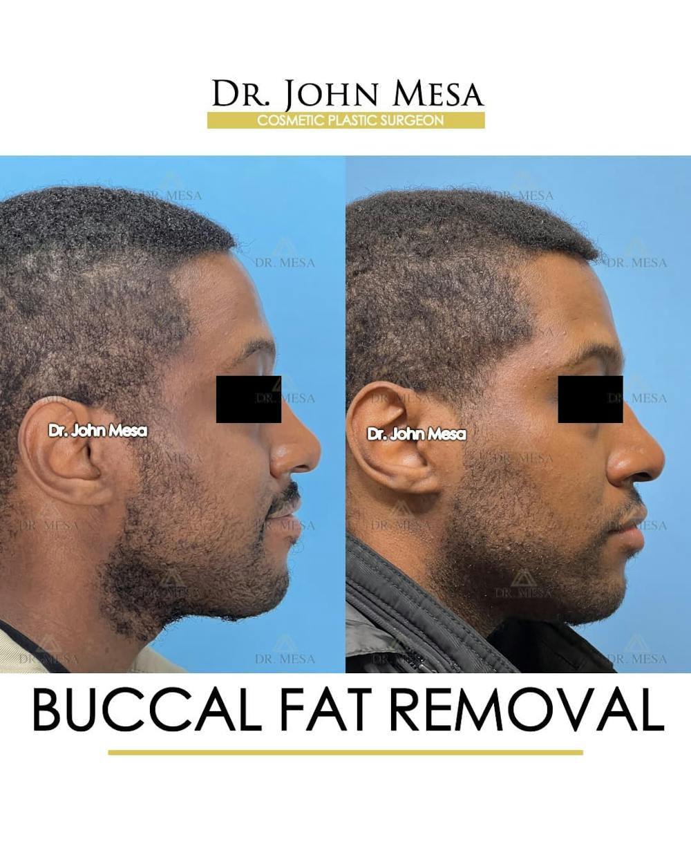 Buccal Fat Pad Removal for Men Before & After Gallery - Patient 624194 - Image 5