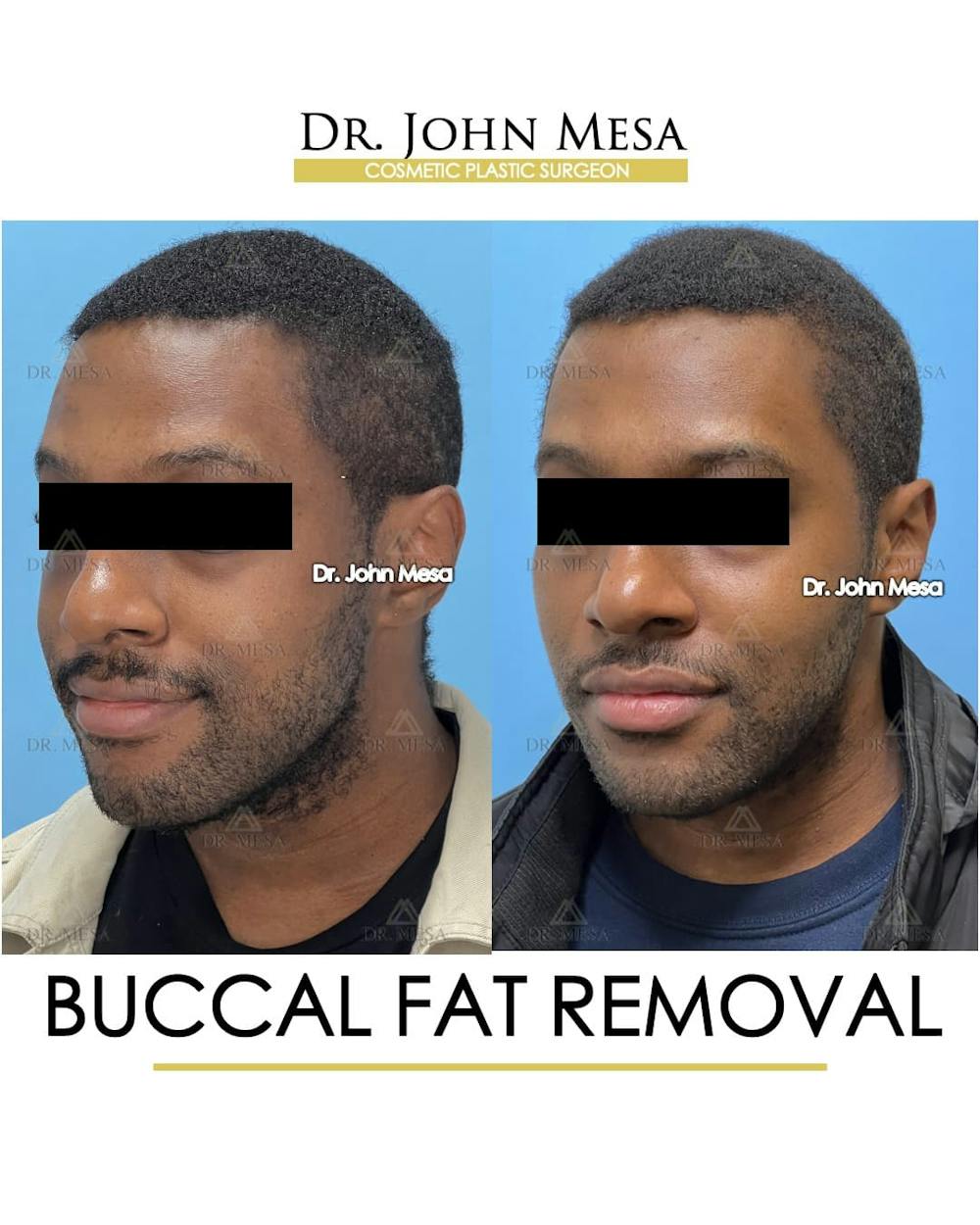 Buccal Fat Pad Removal for Men Before & After Gallery - Patient 624194 - Image 6