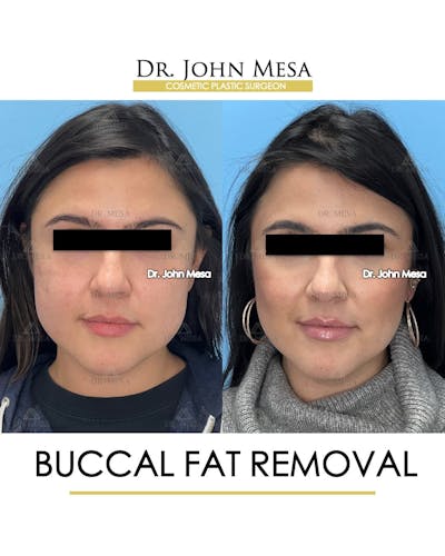 Buccal Fat Pad Removal Before & After Gallery - Patient 240449 - Image 1