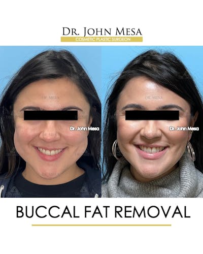 Buccal Fat Pad Removal Before & After Gallery - Patient 240449 - Image 2