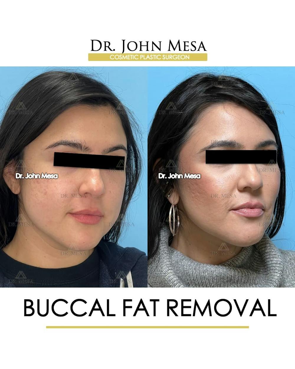 Buccal Fat Pad Removal Before & After Gallery - Patient 240449 - Image 3