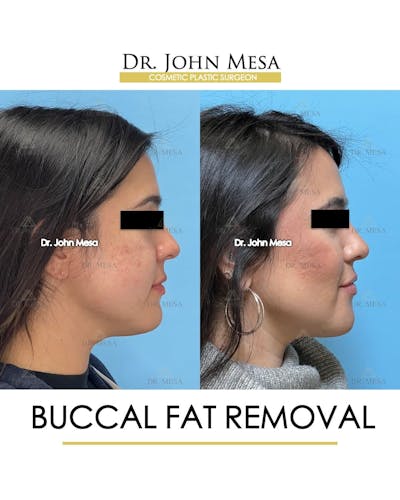 Buccal Fat Pad Removal Before & After Gallery - Patient 240449 - Image 4