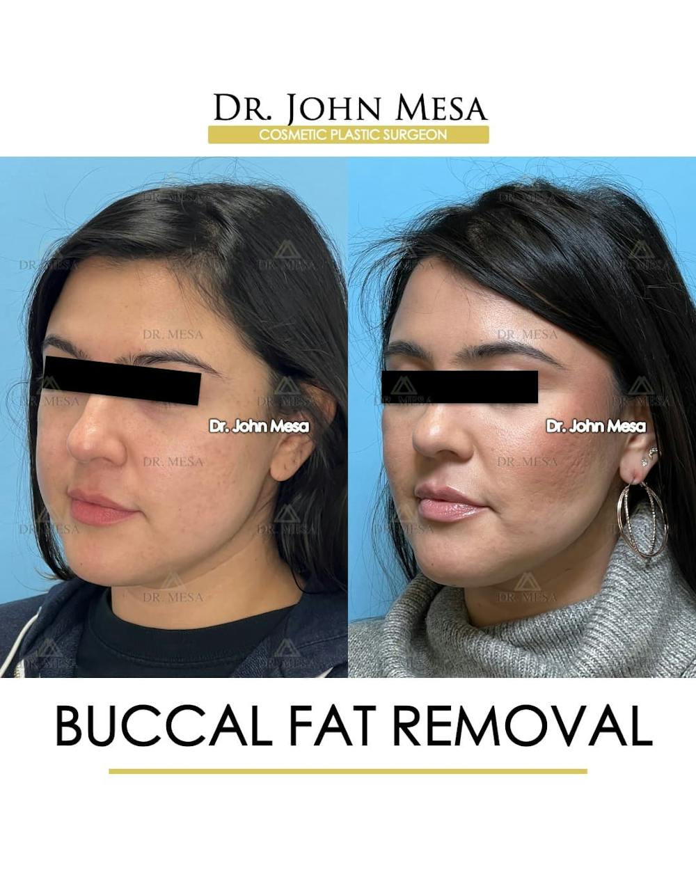 Buccal Fat Pad Removal Before & After Gallery - Patient 240449 - Image 5