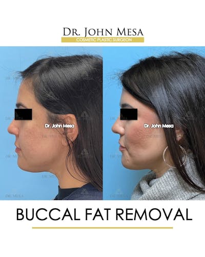 Buccal Fat Pad Removal Before & After Gallery - Patient 240449 - Image 6