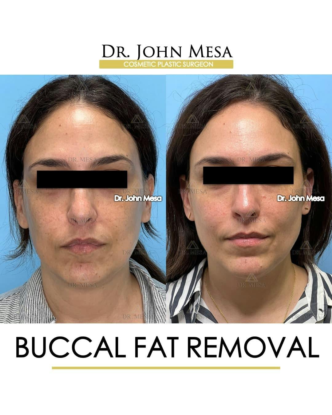 Buccal Fat Pad Removal Before & After Gallery - Patient 174757 - Image 1