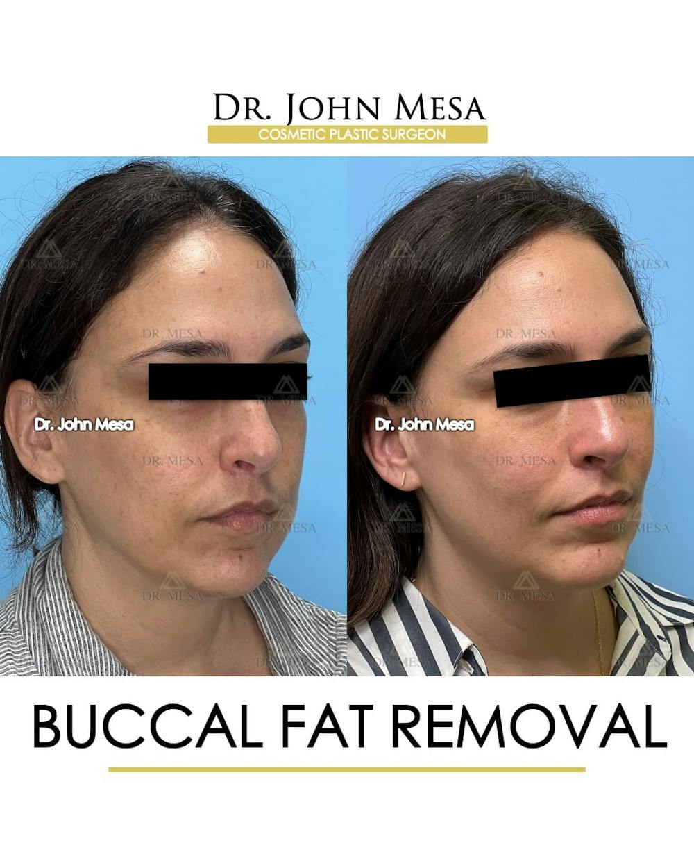 Buccal Fat Pad Removal Before & After Gallery - Patient 174757 - Image 2