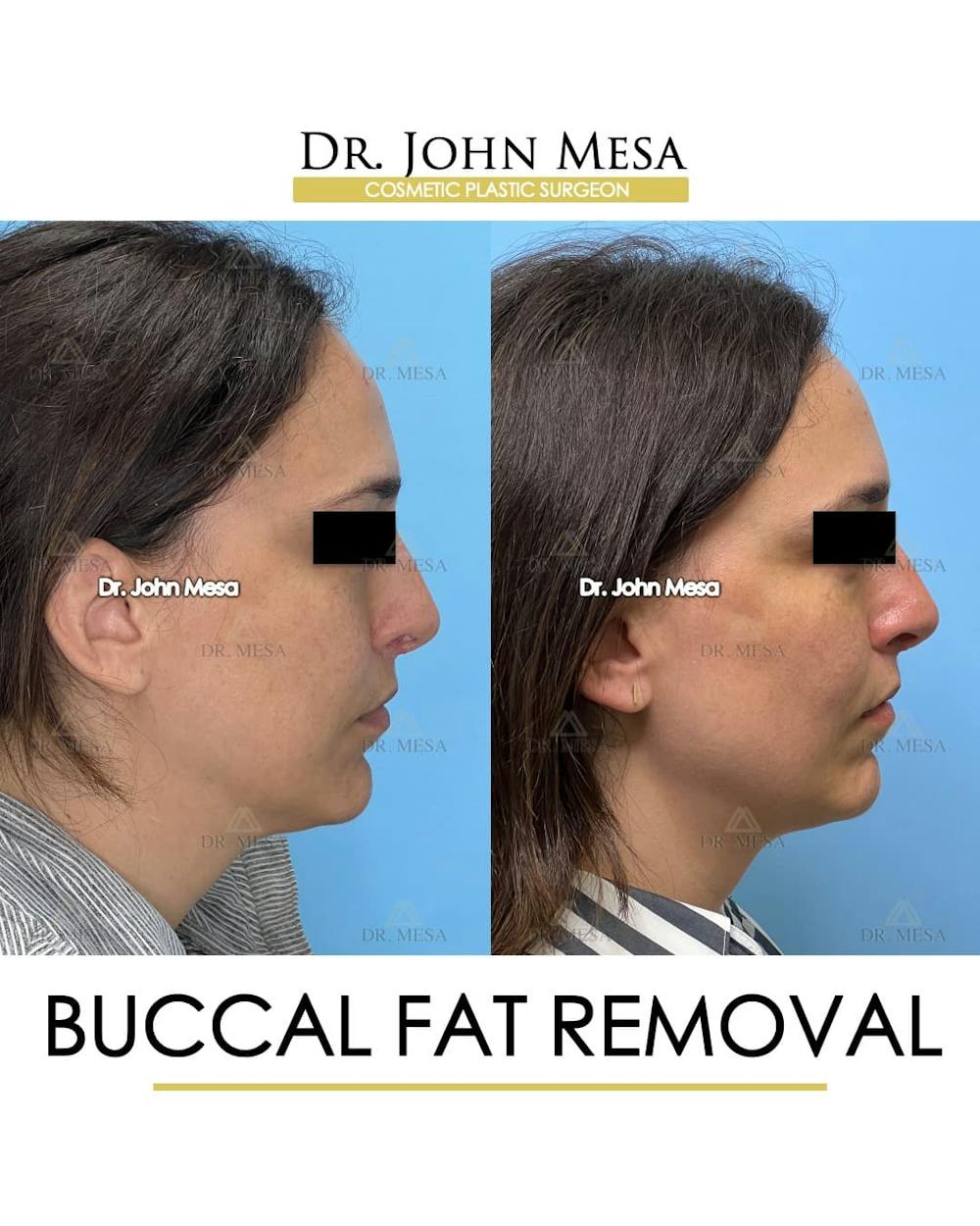 Buccal Fat Pad Removal Before & After Gallery - Patient 174757 - Image 3