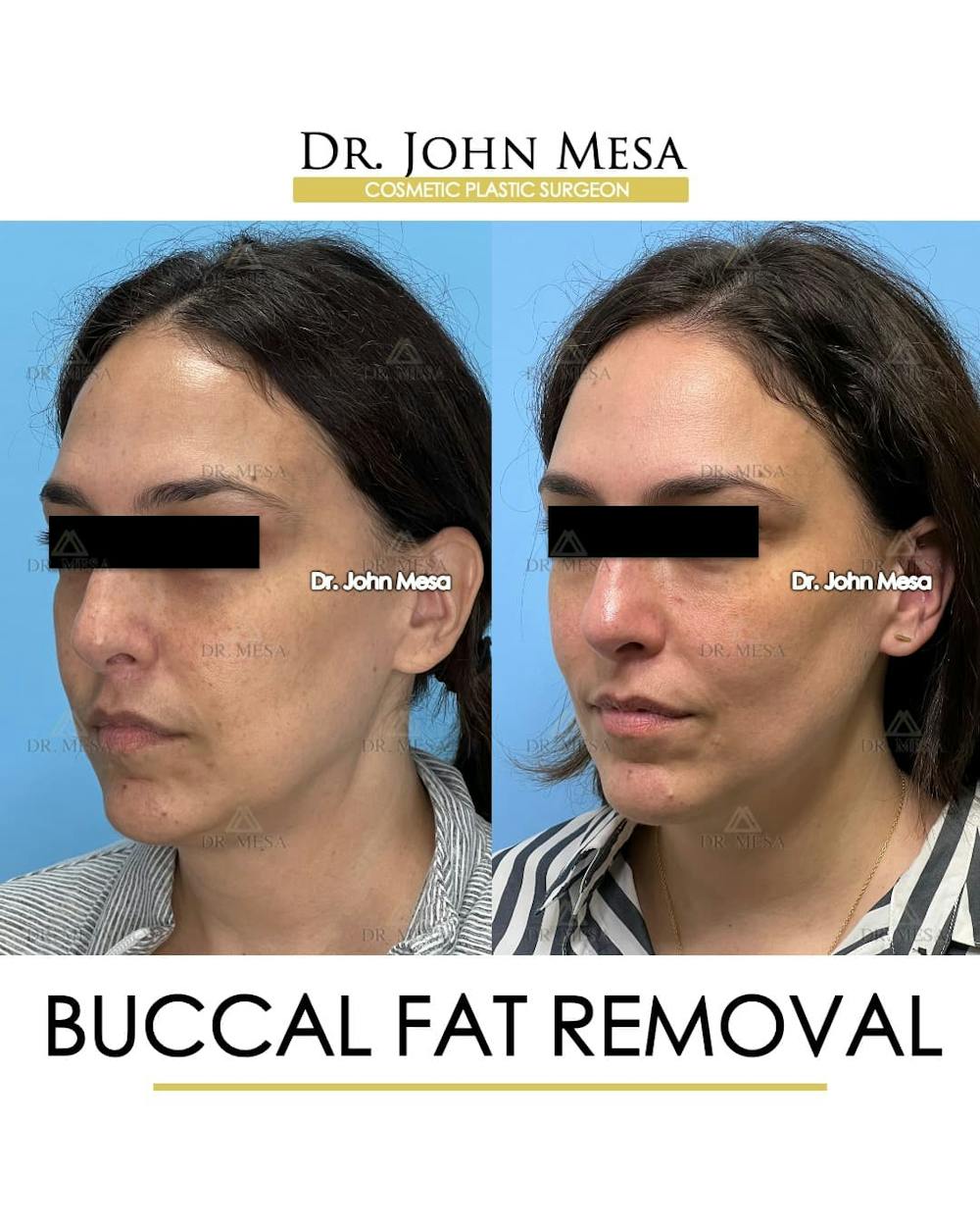 Buccal Fat Pad Removal Before & After Gallery - Patient 174757 - Image 4