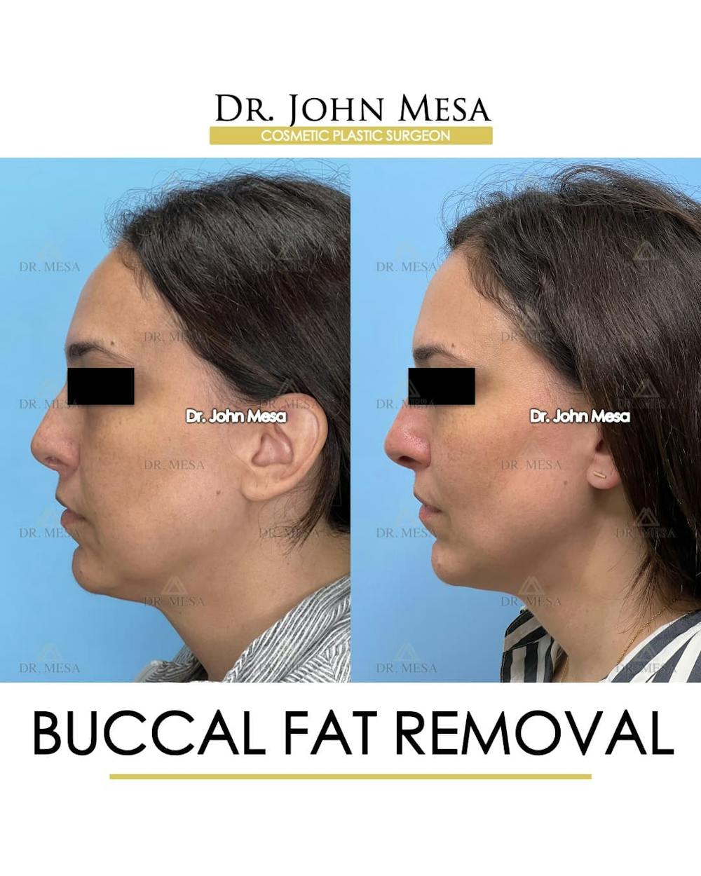Buccal Fat Pad Removal Before & After Gallery - Patient 174757 - Image 5