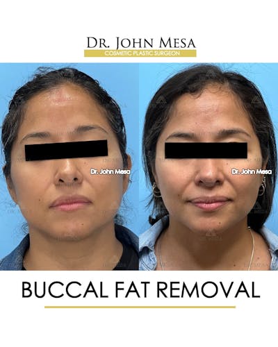 Buccal Fat Pad Removal Before & After Gallery - Patient 830648 - Image 1