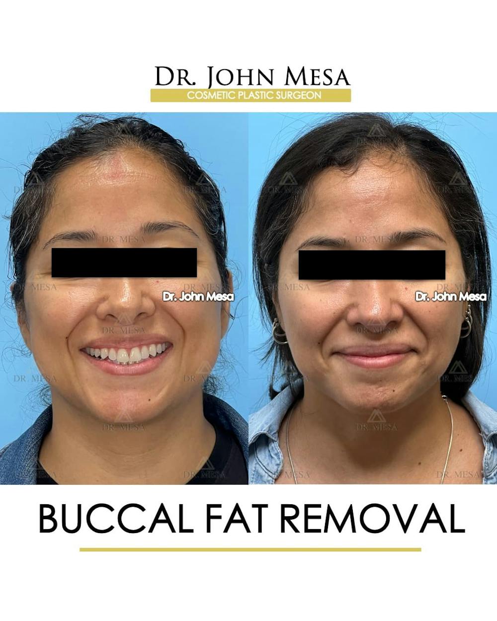 Buccal Fat Pad Removal Before & After Gallery - Patient 830648 - Image 2
