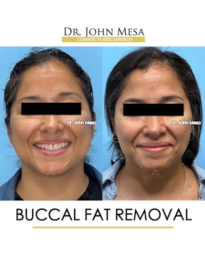 Buccal Fat Pad Removal Before & After Gallery - Patient 830648 - Image 2