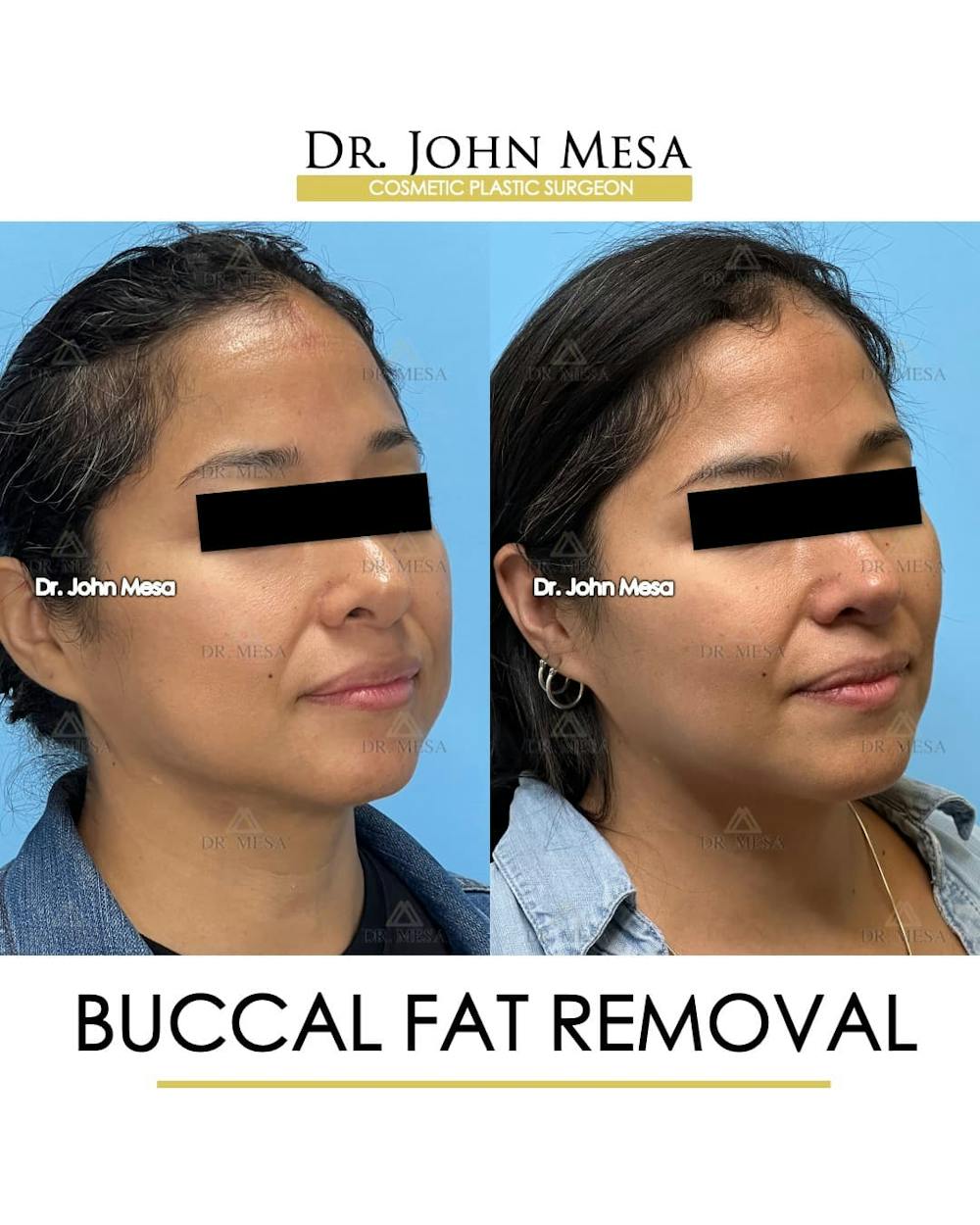 Buccal Fat Pad Removal Before & After Gallery - Patient 830648 - Image 3