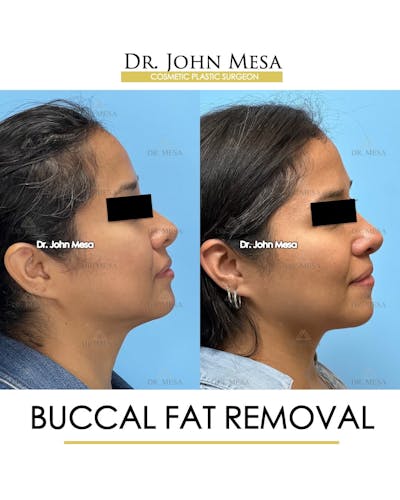 Buccal Fat Pad Removal Before & After Gallery - Patient 830648 - Image 4