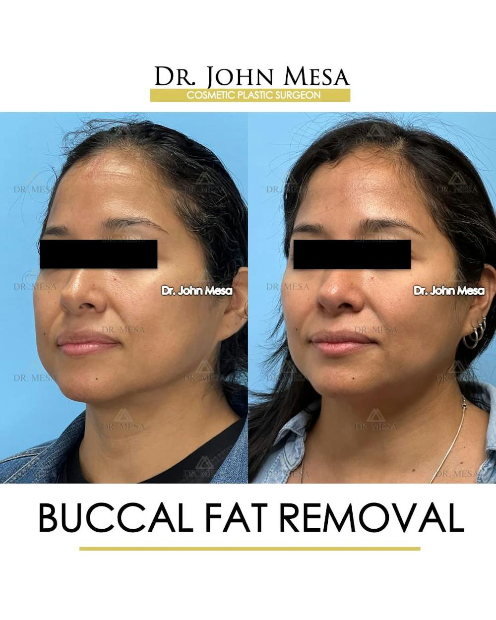Buccal Fat Pad Removal Before & After Gallery - Patient 830648 - Image 5