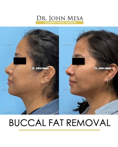 Buccal Fat Pad Removal Before & After Gallery - Patient 830648 - Image 6