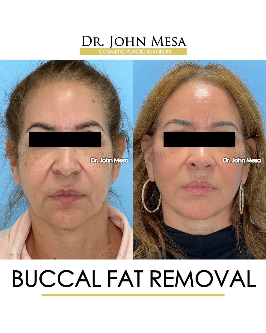 Buccal Fat Pad Removal Before & After Gallery - Patient 336905 - Image 1