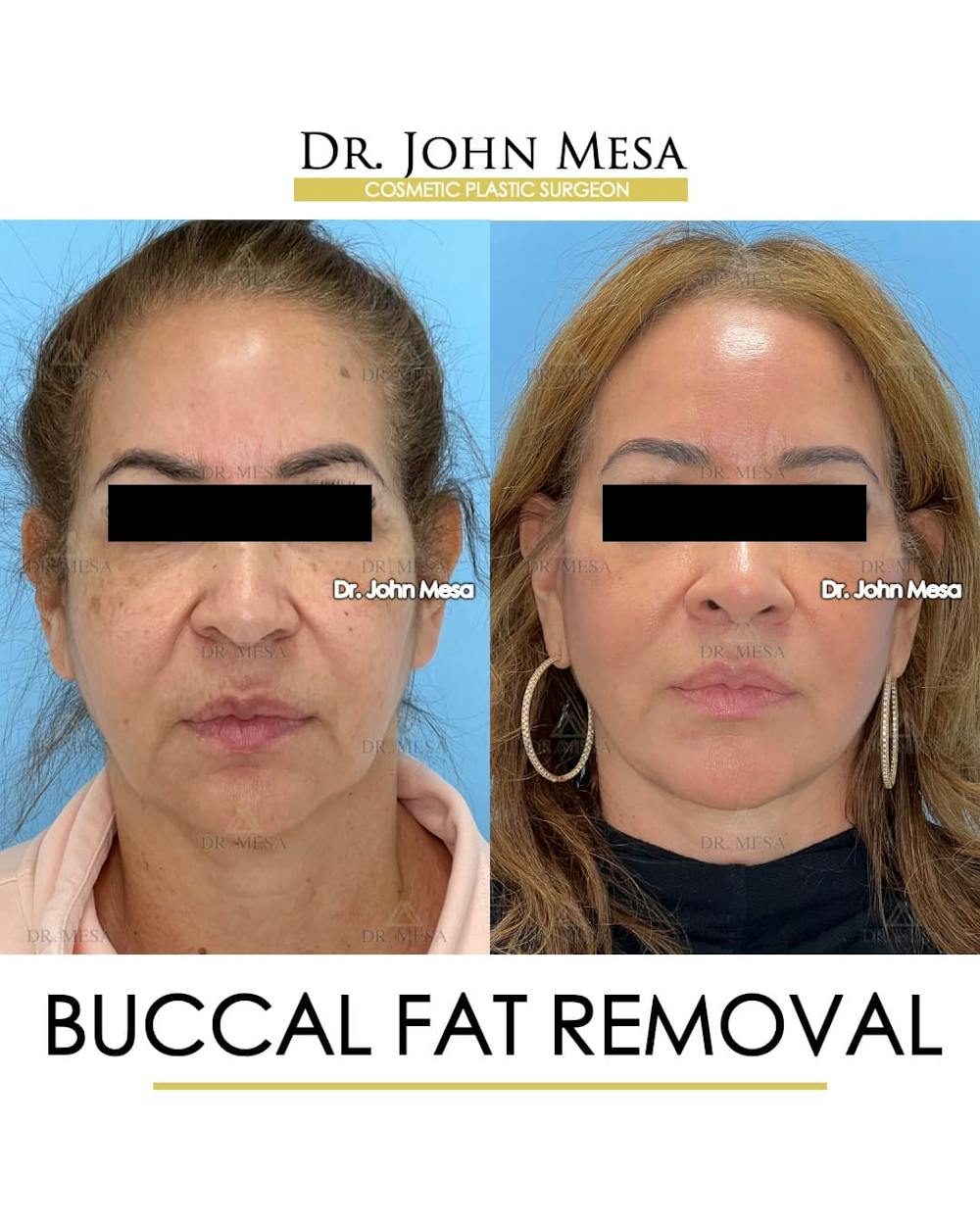 Buccal Fat Pad Removal Before & After Gallery - Patient 336905 - Image 1
