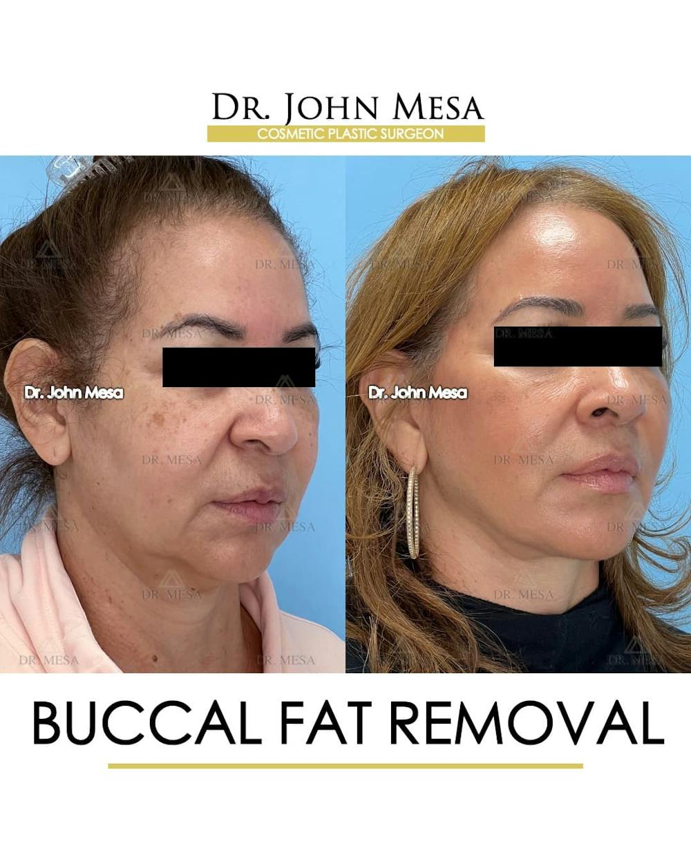 Buccal Fat Pad Removal Before & After Gallery - Patient 336905 - Image 2