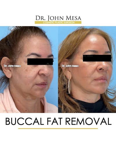 Buccal Fat Pad Removal Before & After Gallery - Patient 336905 - Image 2