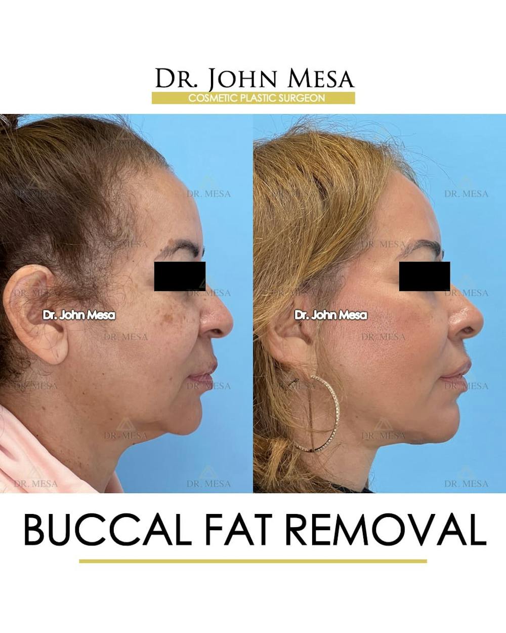 Buccal Fat Pad Removal Before & After Gallery - Patient 336905 - Image 3