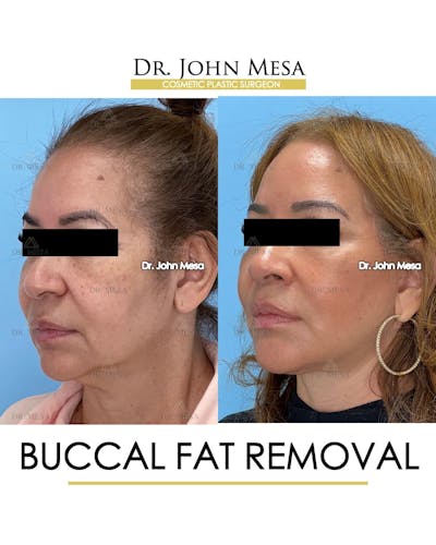 Buccal Fat Pad Removal Before & After Gallery - Patient 336905 - Image 4