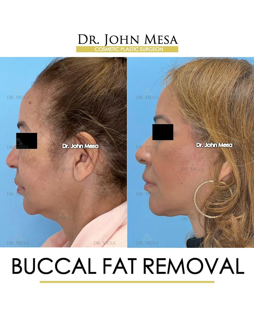 Buccal Fat Pad Removal Before & After Gallery - Patient 336905 - Image 5