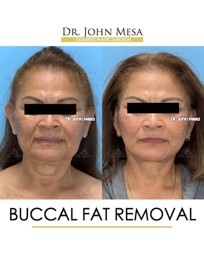 Buccal Fat Pad Removal Before & After Gallery - Patient 204575 - Image 1