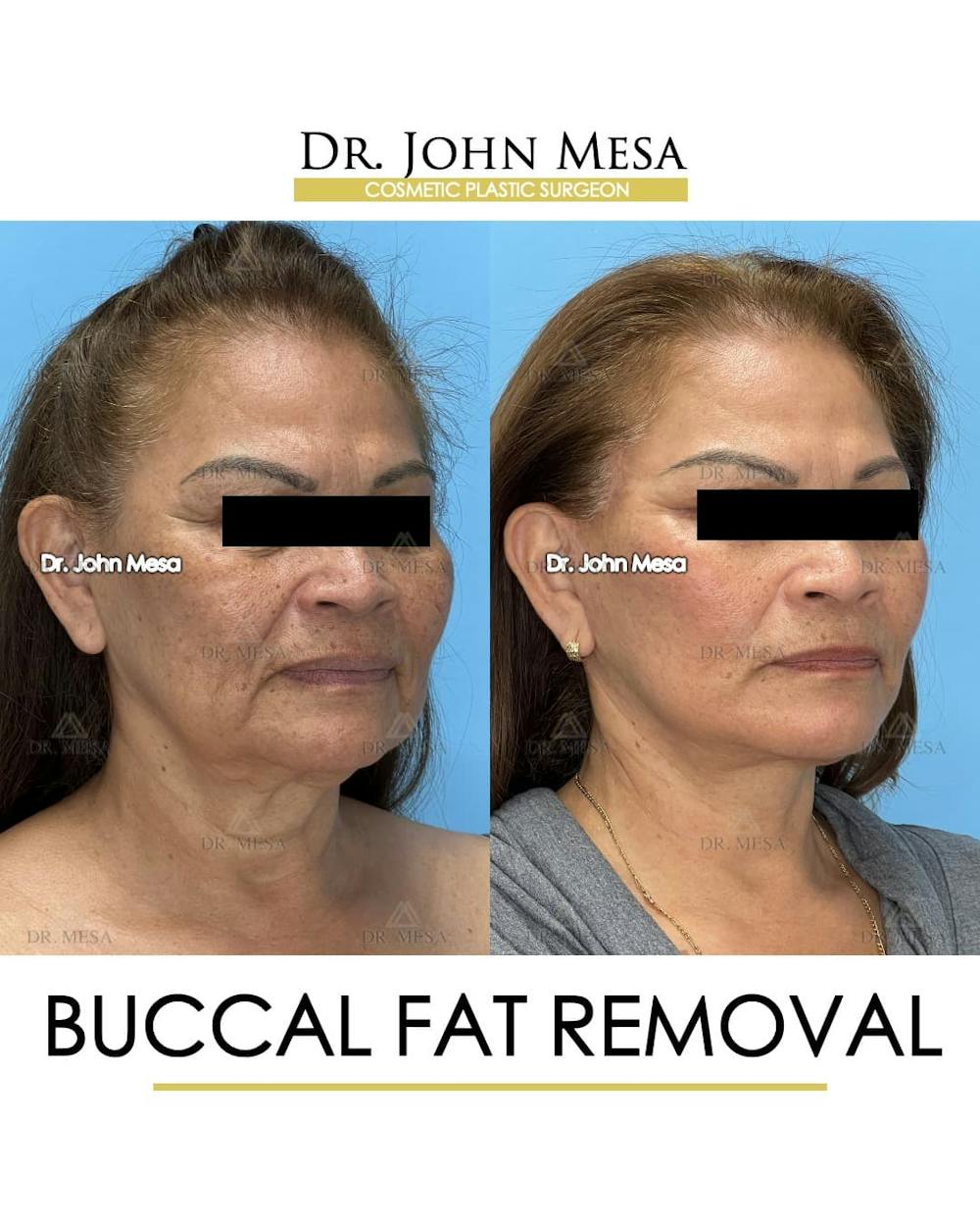 Buccal Fat Pad Removal Before & After Gallery - Patient 204575 - Image 2