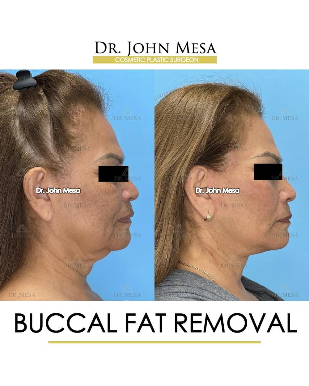 Buccal Fat Pad Removal Before & After Gallery - Patient 204575 - Image 3