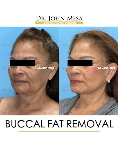 Buccal Fat Pad Removal Before & After Gallery - Patient 204575 - Image 4