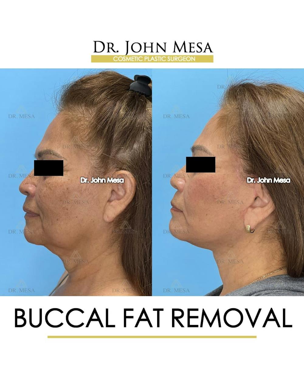 Buccal Fat Pad Removal Before & After Gallery - Patient 204575 - Image 5