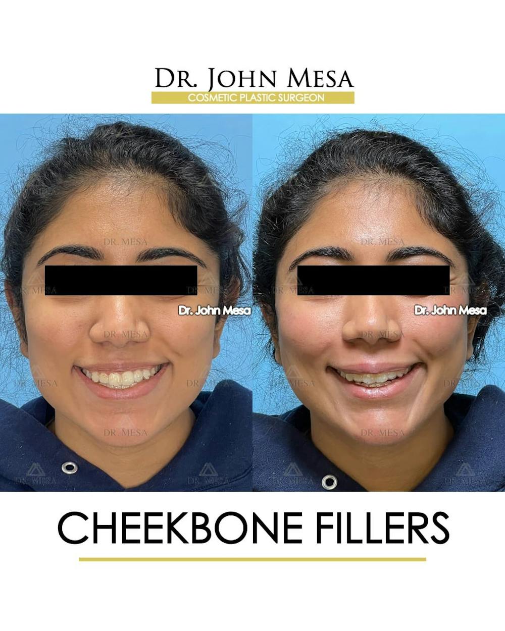 Cheekbone Filler Before & After Gallery - Patient 862796 - Image 2