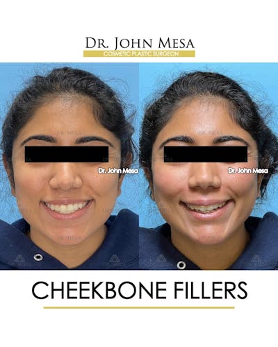 Cheekbone Filler Before & After Gallery - Patient 862796 - Image 2