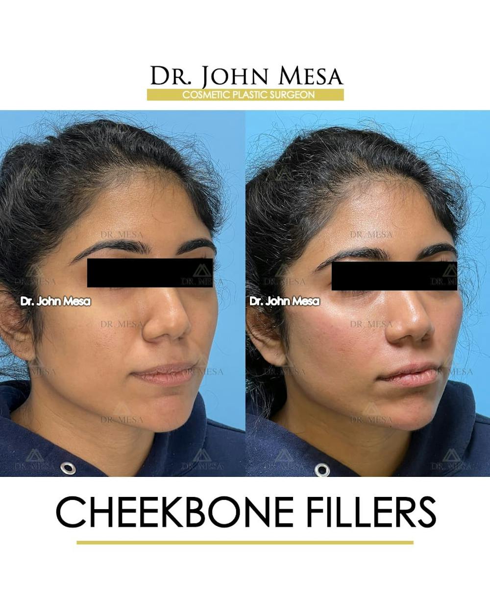 Cheekbone Filler Before & After Gallery - Patient 862796 - Image 3